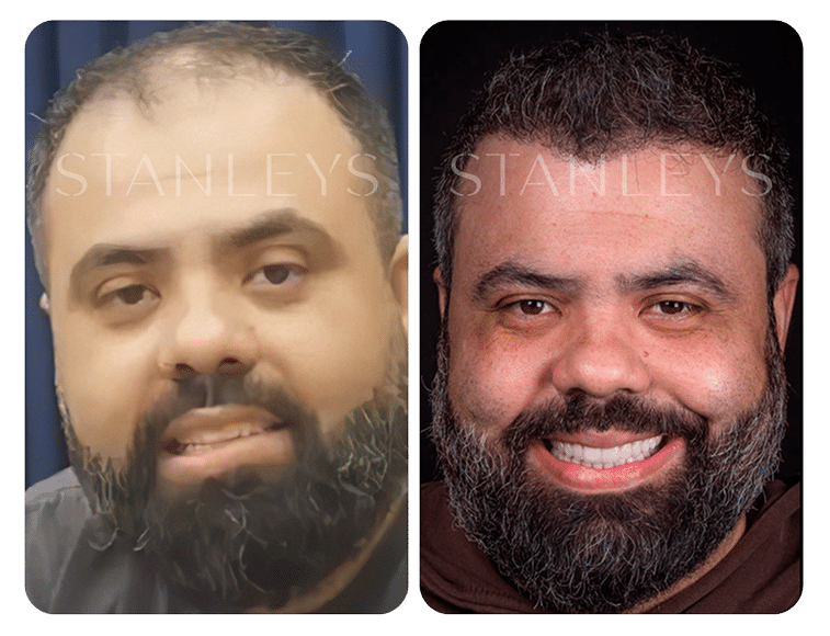 Antes e Depois_LP 19 1