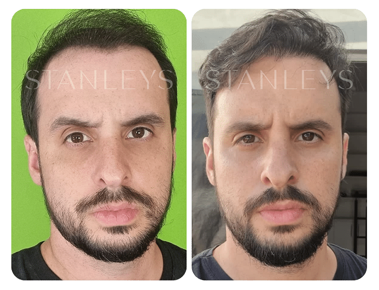 Antes e Depois_LP 22