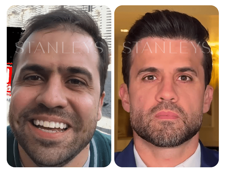 Antes e Depois_LP 23 1