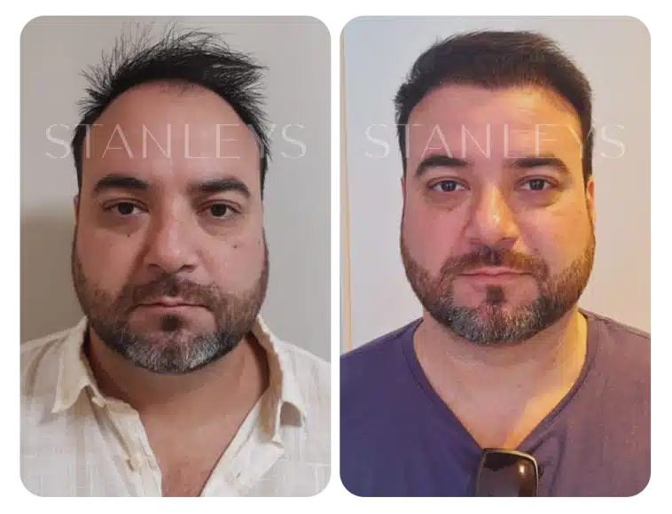 antes_e_depois_lp_01_1_2x