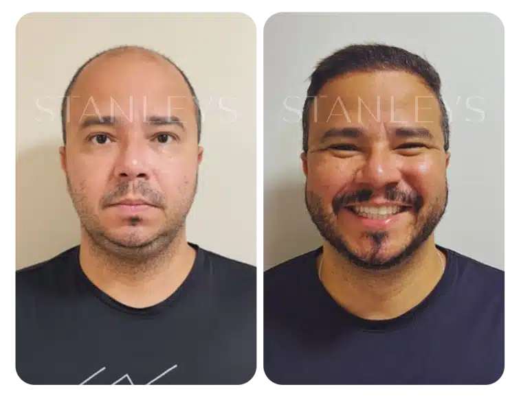 antes_e_depois_lp_03_2x