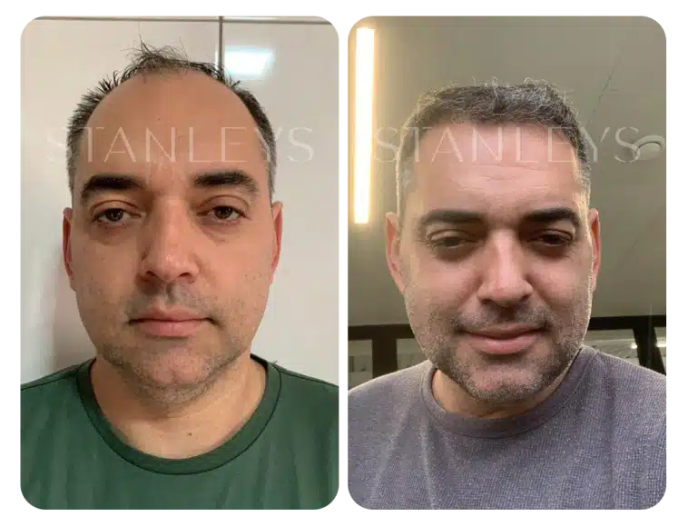 antes_e_depois_lp_04_2x