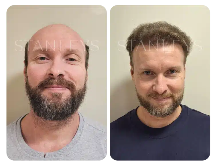 antes_e_depois_lp_06_2x