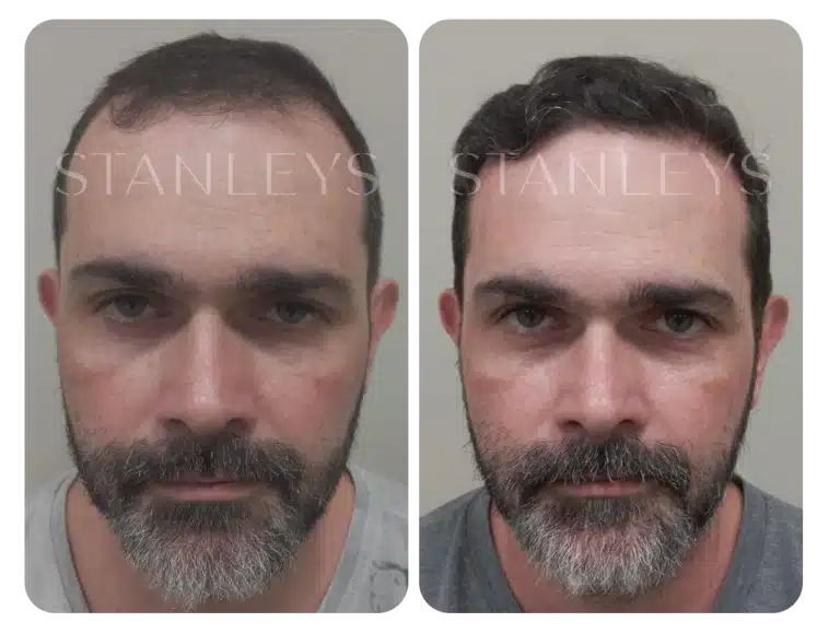 antes_e_depois_lp_07_2x