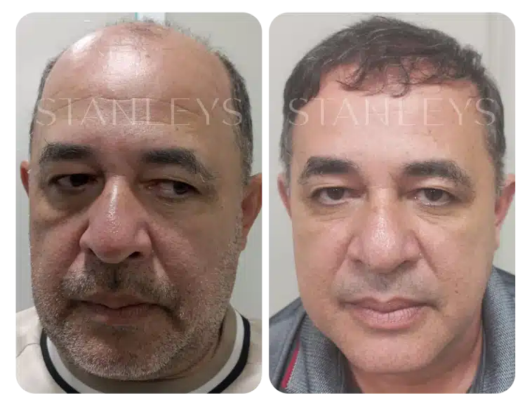 antes_e_depois_lp_08_2x