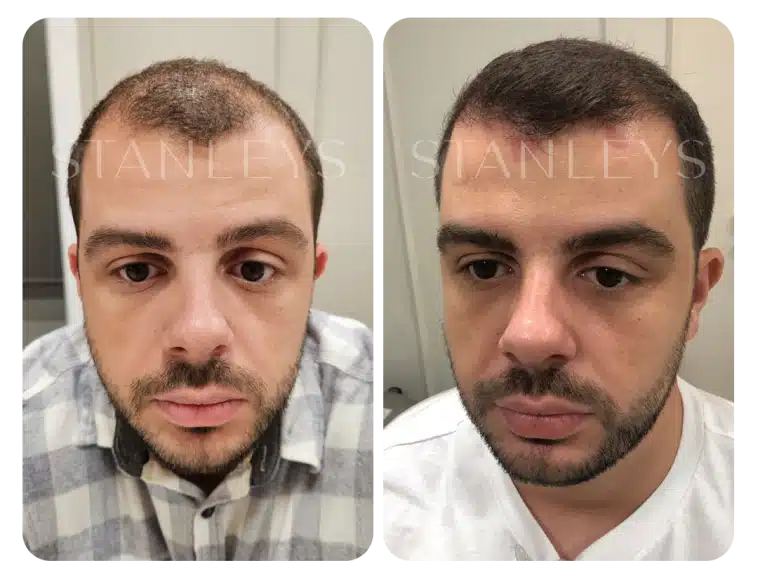 antes_e_depois_lp_10_2x