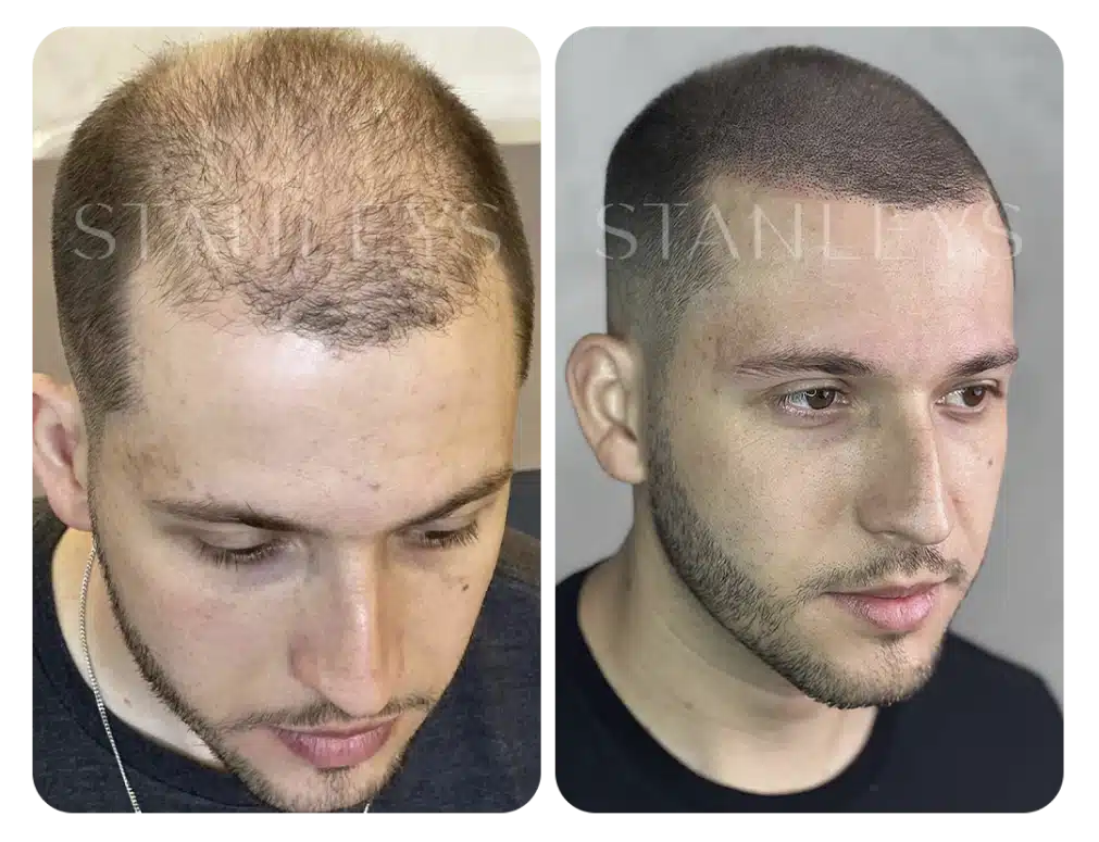 antes_e_depois_nano_1