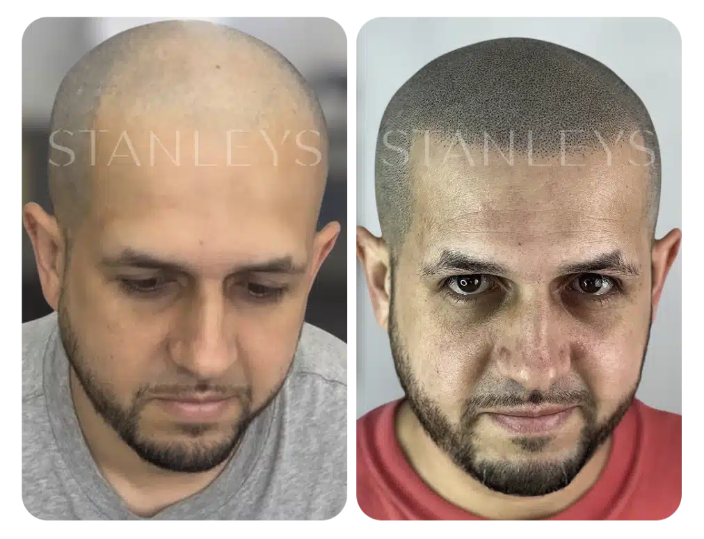 antes_e_depois_nano_2