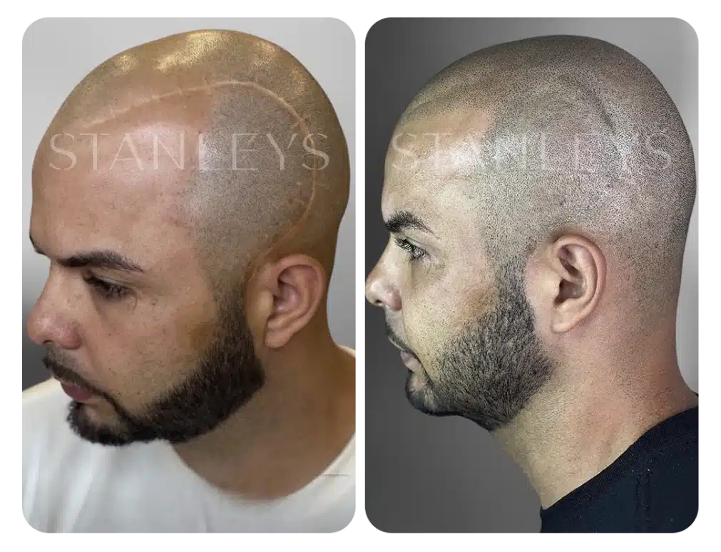 antes_e_depois_nano_3