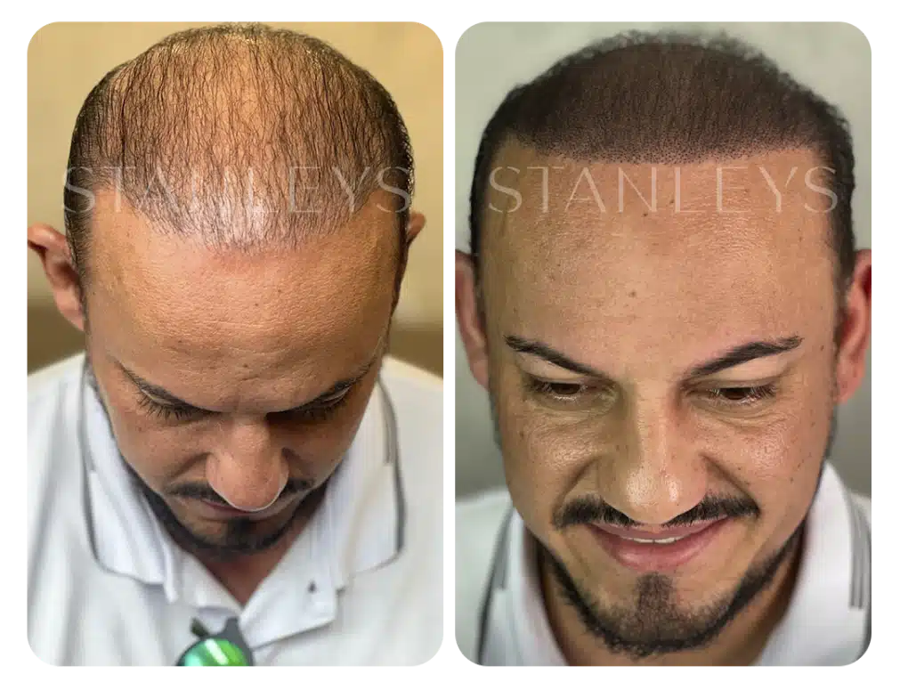 antes_e_depois_nano_4