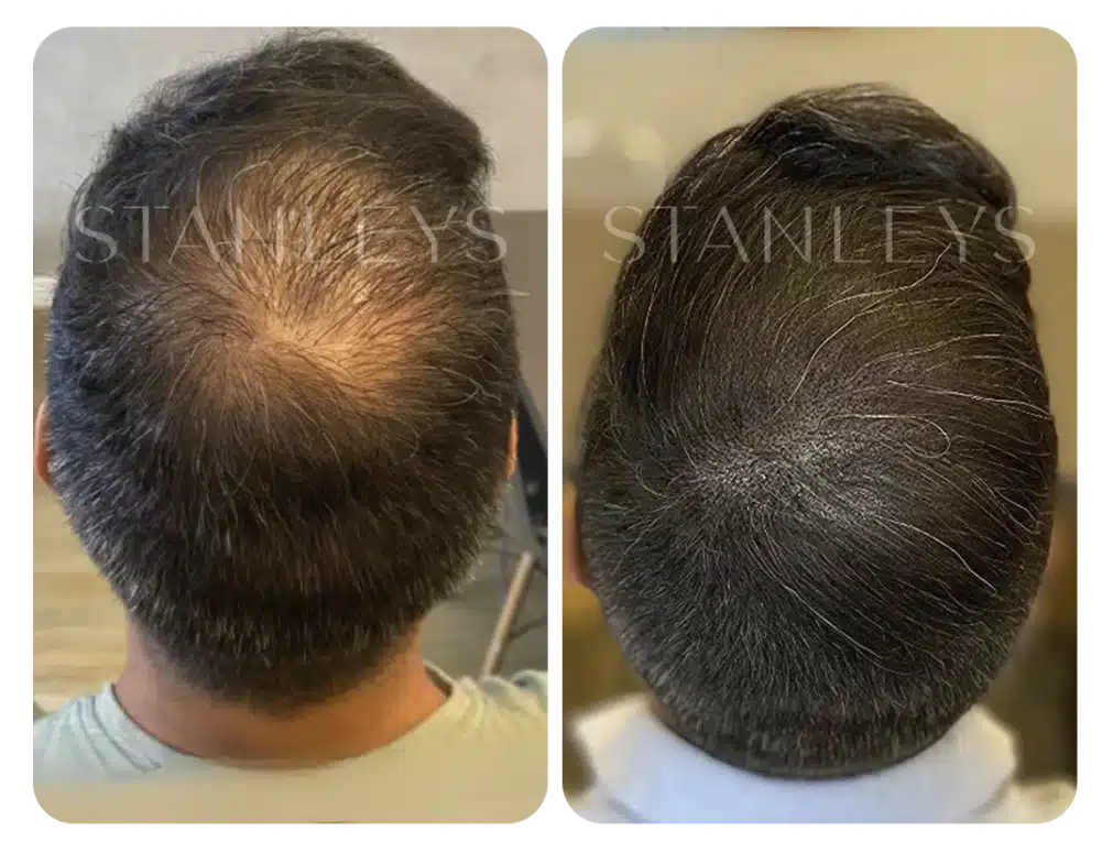 antes_e_depois_nano_5