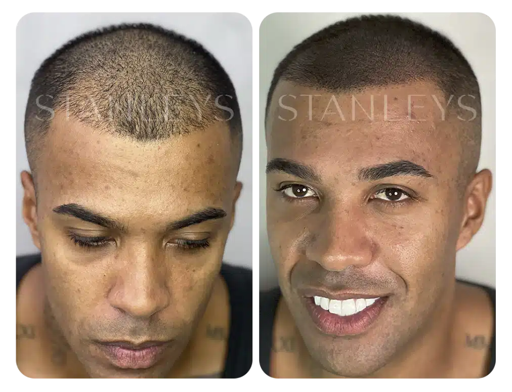 antes_e_depois_nano_6