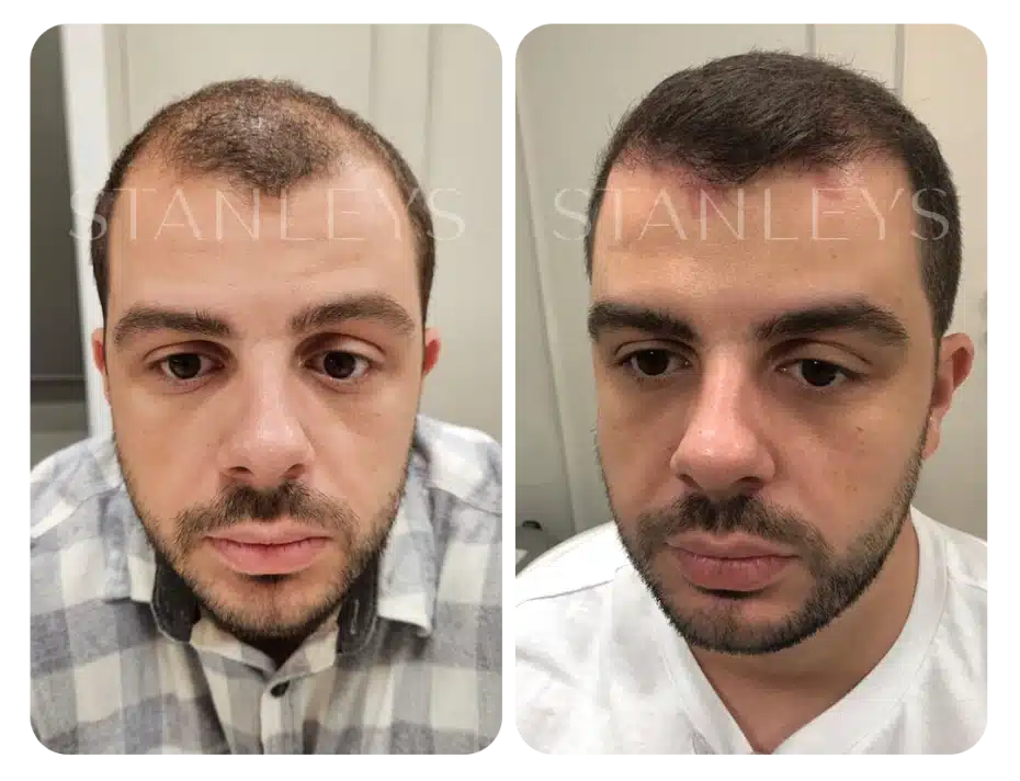 antes_e_depois_lp_10_2x.webp