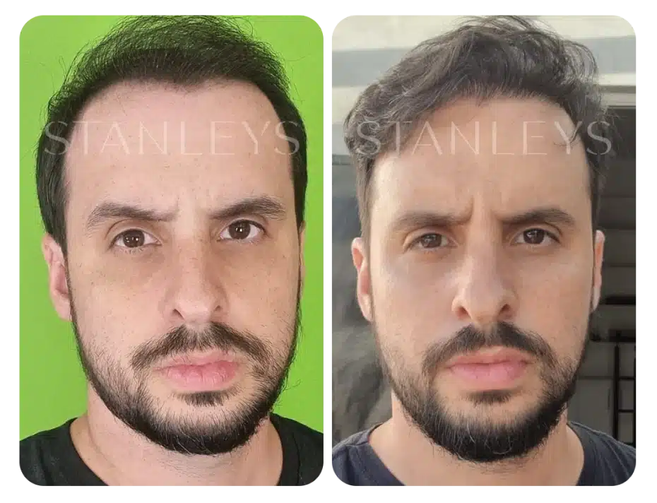 antes_e_depois_lp_22_2x.webp