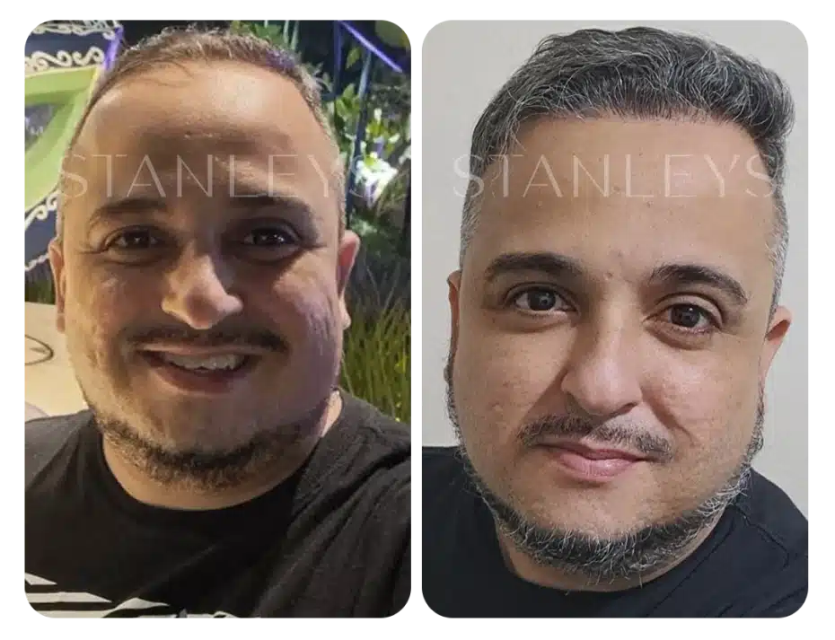 antes_e_depois_lp_24_2x.webp