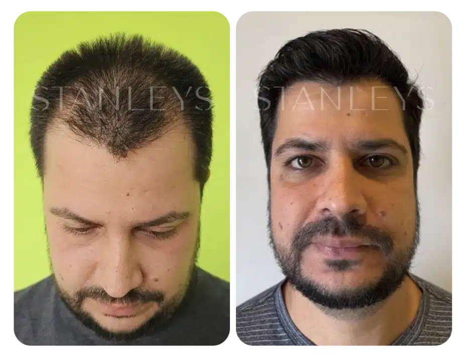 antes_e_depois_lp_28_2x.webp