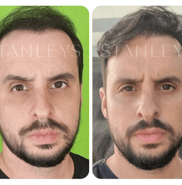 Antes-e-Depois_LP-22.png